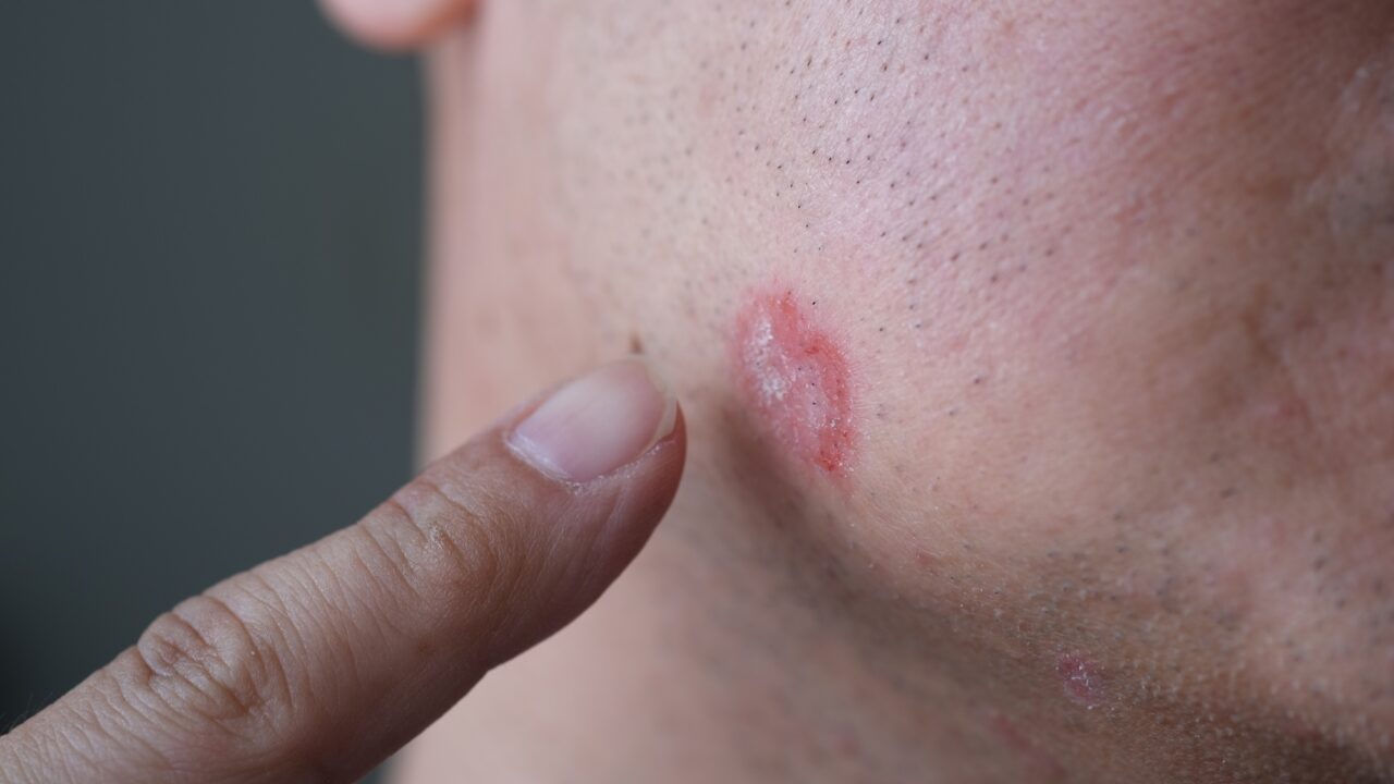 psoriasis-paa-kind-hos-mand