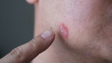psoriasis-paa-kind-hos-mand