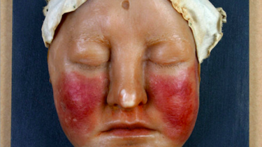 Kvinde med sygdommen lupus erythem