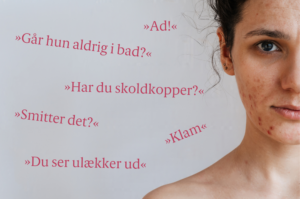 Kvinde med akne og de fordomme, hun møder
