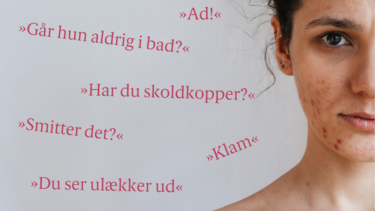 Kvinde med akne og de fordomme, hun møder