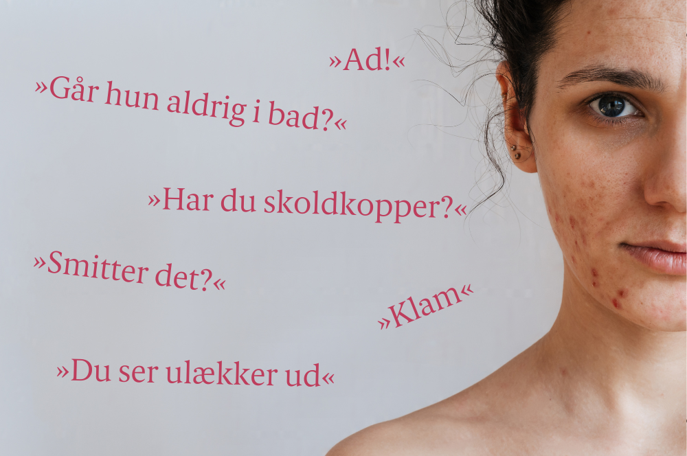 Kvinde med akne og de fordomme, hun møder