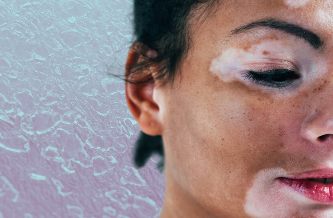 Hudsygdommen vitiligo