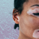 Hudsygdommen vitiligo