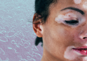 Hudsygdommen vitiligo