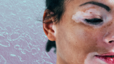 Hudsygdommen vitiligo