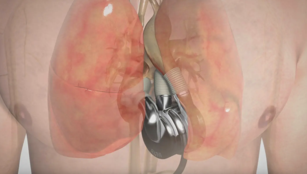 BiVACOR Total Artificial Heart er lavet af titanium og er beregnet til at erstatte de svigtende hjertekamre i et sygt hjerte.