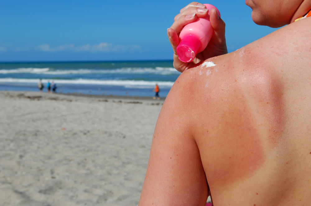 Kvinde på stranden - hun skal til at smøre solcreme på skulderen