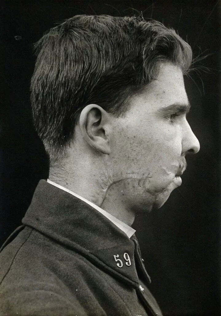 Profilbillede af en ung mand i uniform med nummer 59 på kraven, med synlige ar og misdannelser på kæben og halsen, muligvis fra en skade.