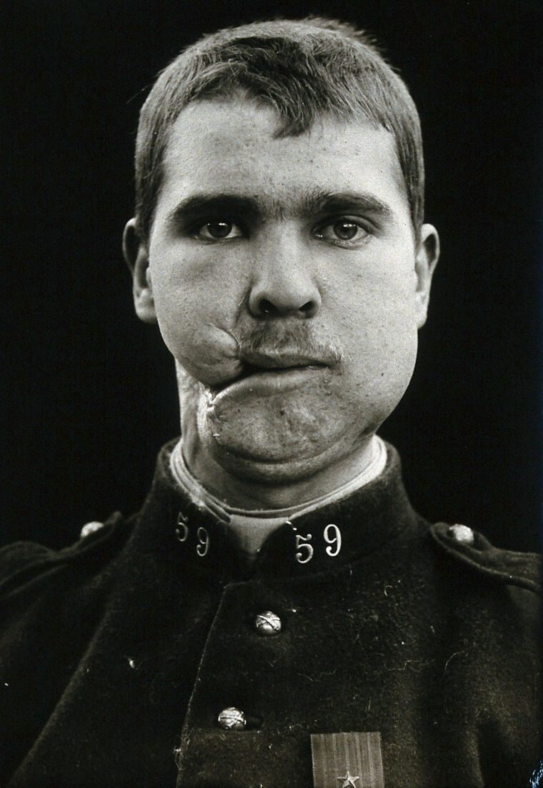 Et sort-hvidt portræt af en mand i militæruniform med nummer 59 og en synlig ansigtsskade på underlæben og kinden. Han kigger direkte ind i kameraet og ser højtidelig ud.