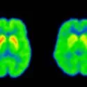 Et PET-scanningsbillede, der viser to hjernescanninger side om side med områder, der er farvet grønne, blå og gule; den venstre scanning har tydelige røde og gule områder, mens den højre scanning viser en mere diffus farve.