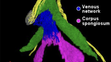 Et farvekodet anatomisk 3D-billede viser de dorsale nerver i klitoris (gul), corpus cavernosum (grøn), det venøse netværk (blå) og corpus spongiosum (pink) med en retningsbestemt akse nederst til venstre.