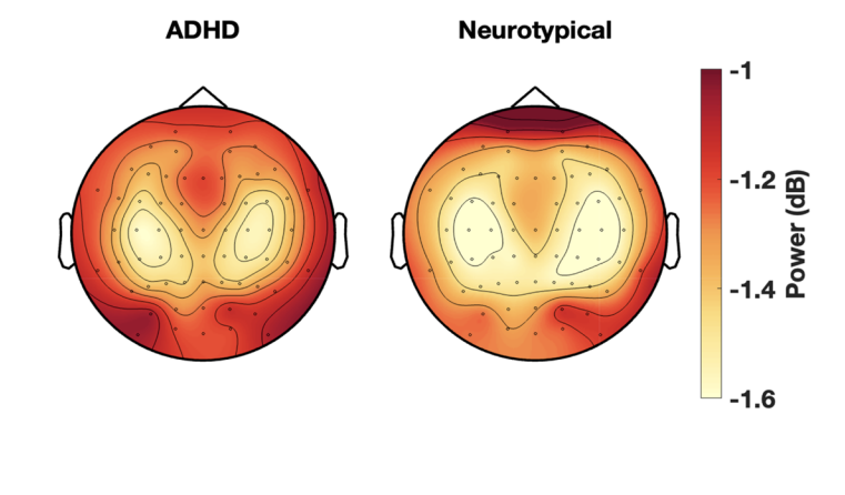 Topografiske hjernekort viser effektfordeling for ADHD- (venstre) og neurotypiske (højre) grupper. Farveskalaen går fra -1,6 dB (gul) til -1 dB (mørkerød) med lignende mønstre, men subtile forskelle i intensitet.