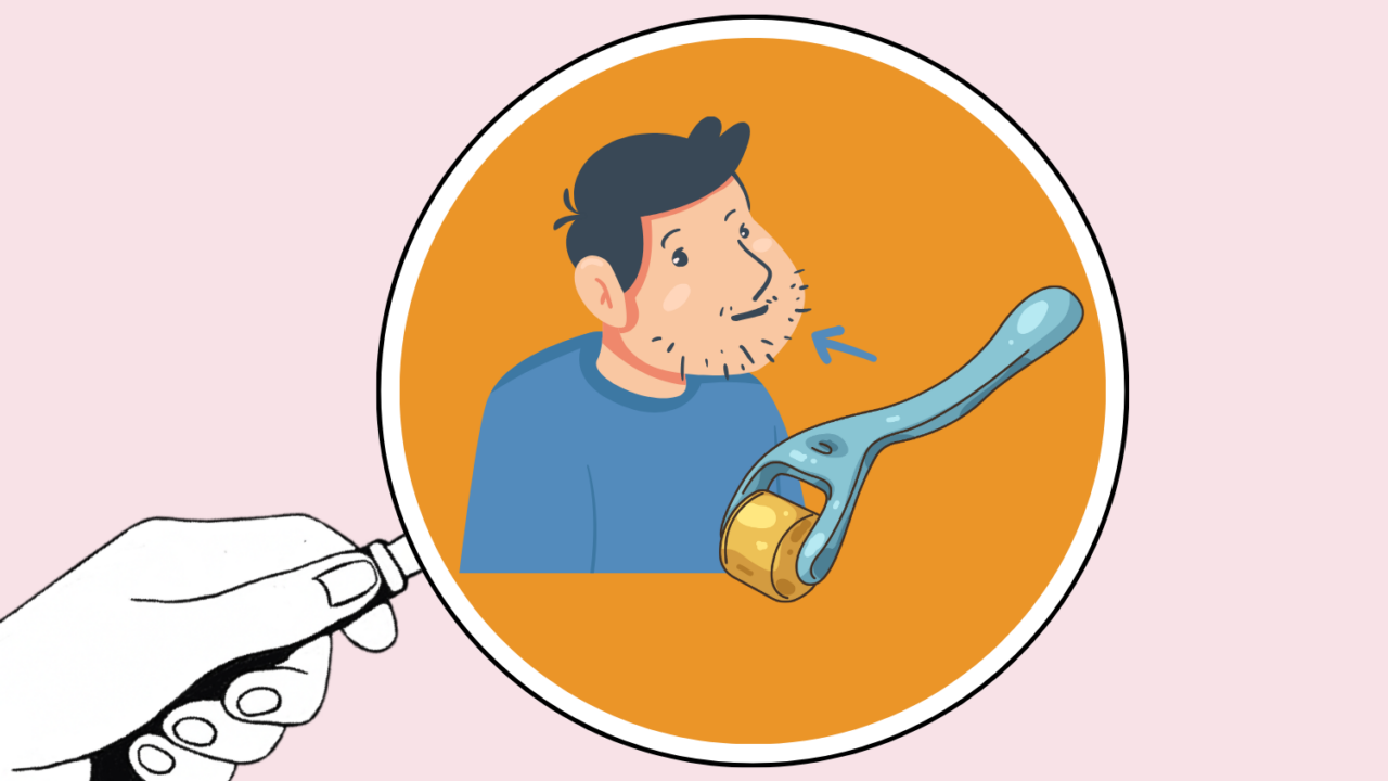 Illustration af en hånd, der holder et forstørrelsesglas, fokuseret på en mand med ujævn ansigtsbehåring, en pil peger på hans skægområde, og en dermaroller er vist ved siden af hans ansigt.