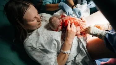 En kvinde i hospitalskjole holder sin nyfødte baby på brystet umiddelbart efter fødslen, mens sundhedspersonalet hjælper til på fødestuen.