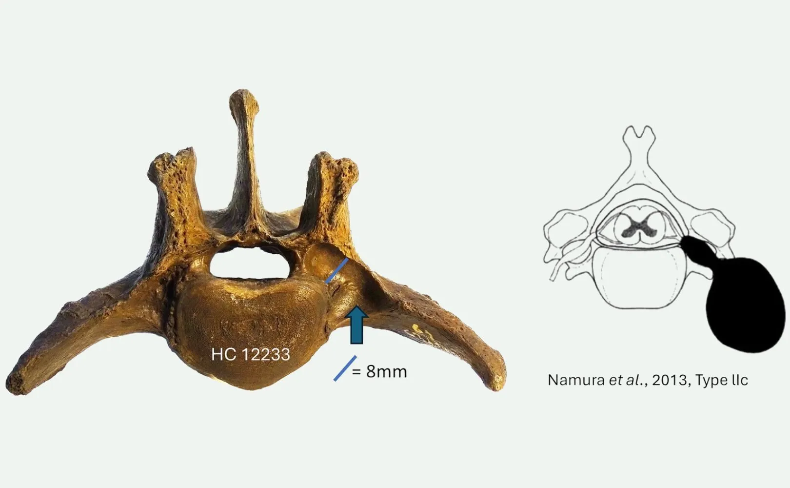 Et fossil af en ryghvirvel med betegnelsen HC 12233, hvor en pil markerer et 8 mm stort træk, vist ved siden af en sort-hvid anatomisk illustration, der fremhæver det samme område. Teksten henviser til Namura et al., 2013, Type IIc.