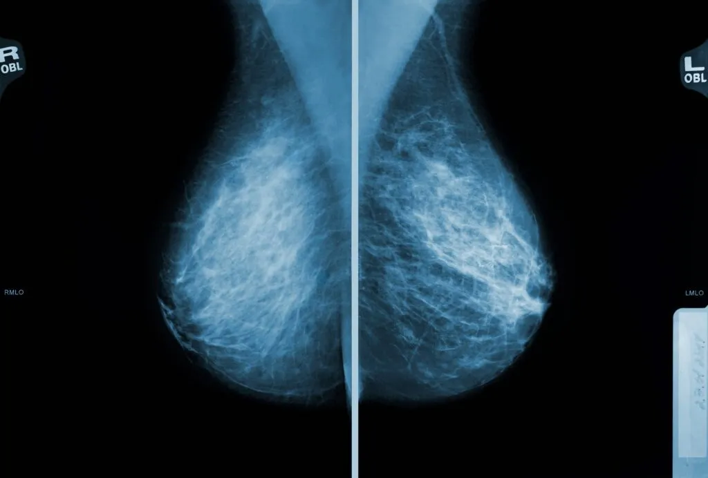 Et mammografi-billede, der viser røntgenoptagelser af begge bryster, placeret side om side til medicinsk undersøgelse. Der ses tæt og fibrøst brystvæv på begge billeder.