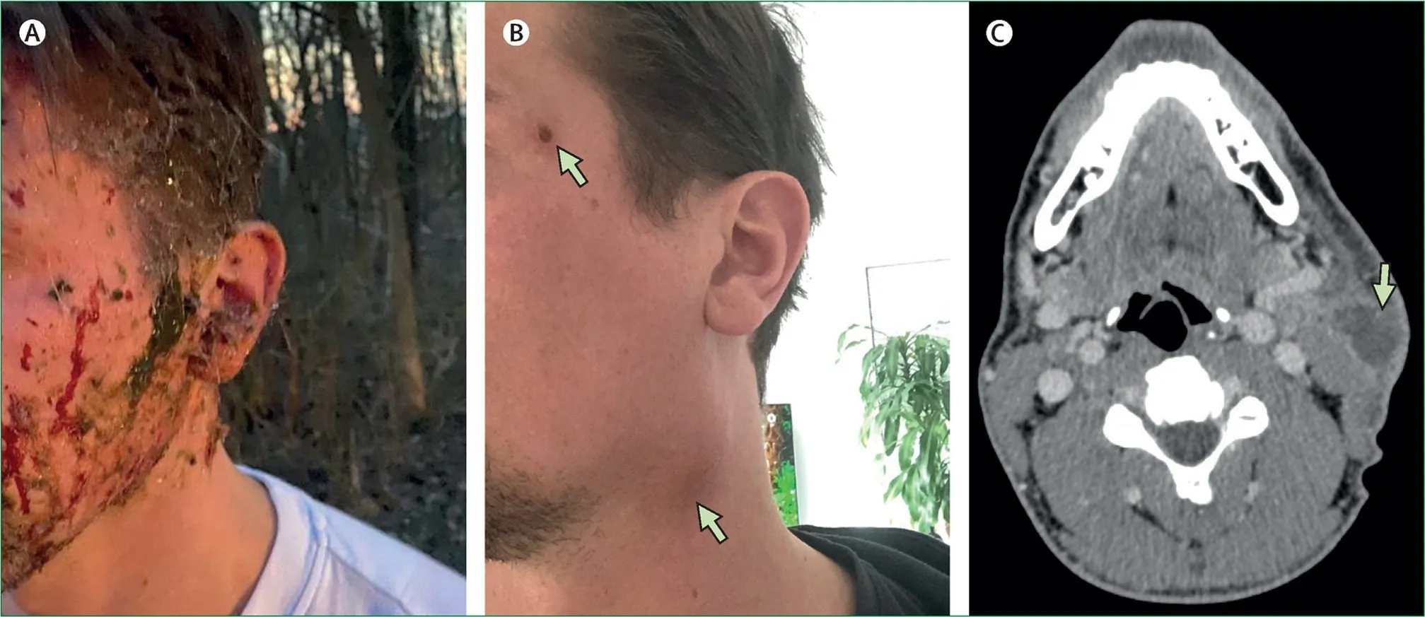 De tre billeder viser: A) et ansigt med sår i ansigtet og fremmedlegemer; B) et sidebillede af en helet kind og hals, hvor pile peger på ar; C) en CT-scanning af halsen, hvor en pil angiver et bestemt område.