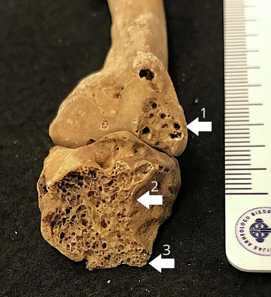 Et fragment af et menneskeknogle ved siden af en metrisk skala, hvor tre pile peger på områder med en porøs overfladestruktur.