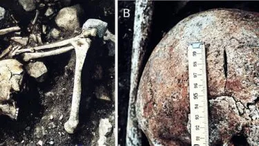A: En arkæologisk grav med et menneskeskalle og lange knogler. B: Et nærbillede af en menneskeskalle med et lineært brud, målt med en lineal.